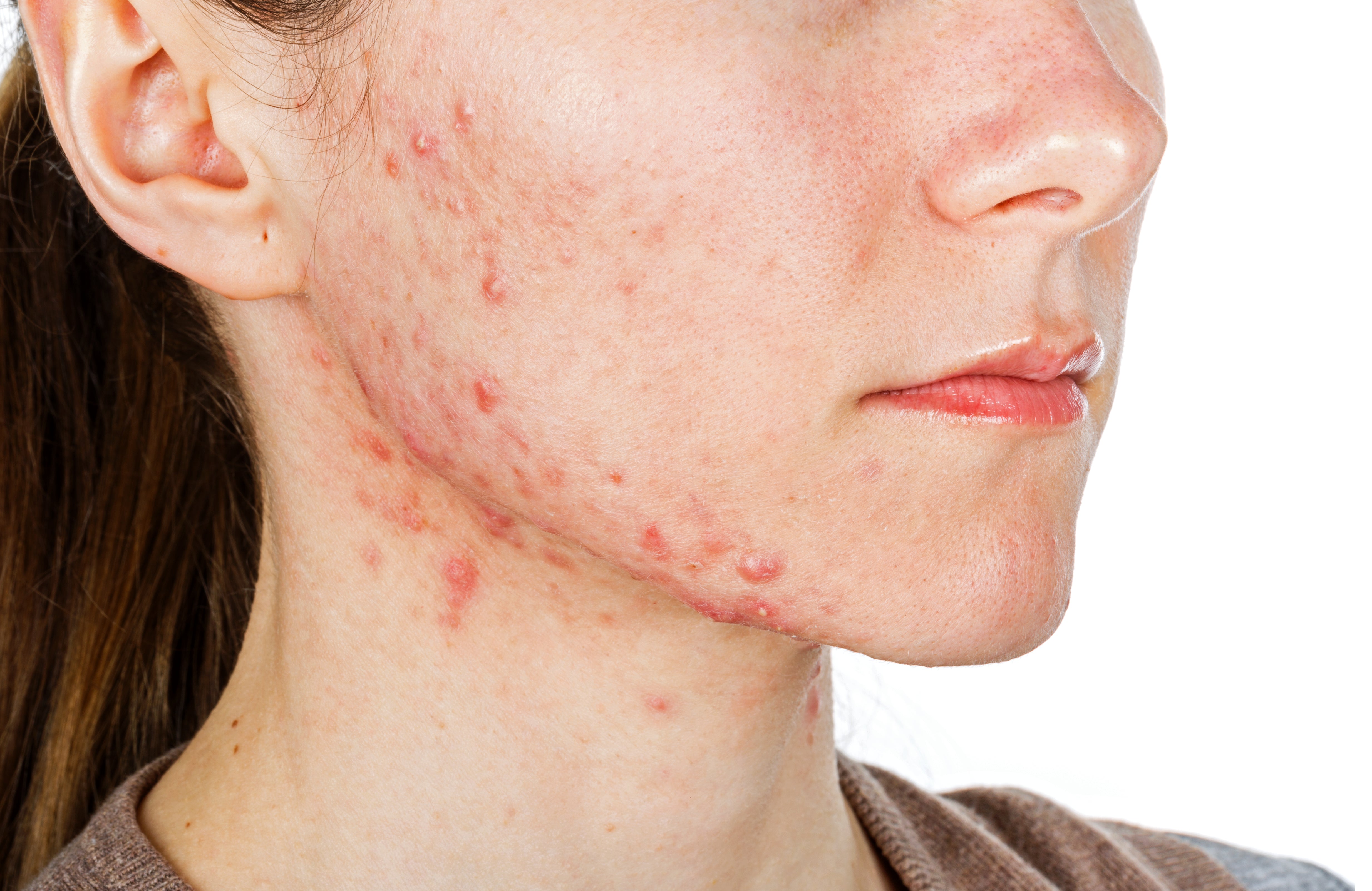 Acne Products and Treatments