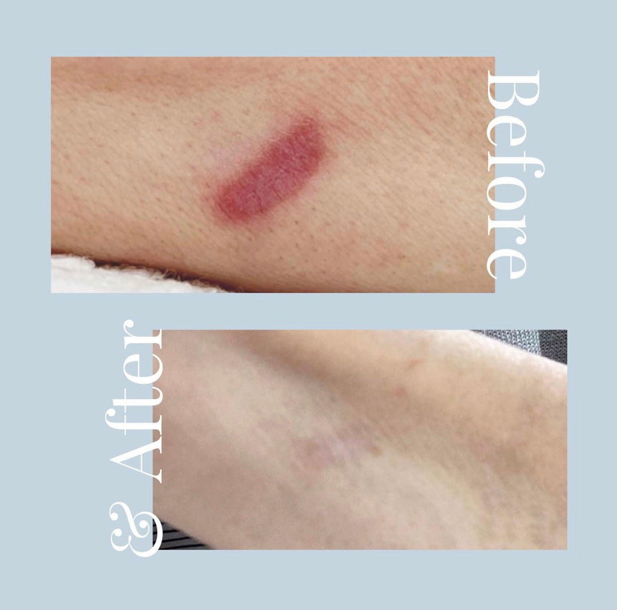 Before and After image of a Skin365 procedure
