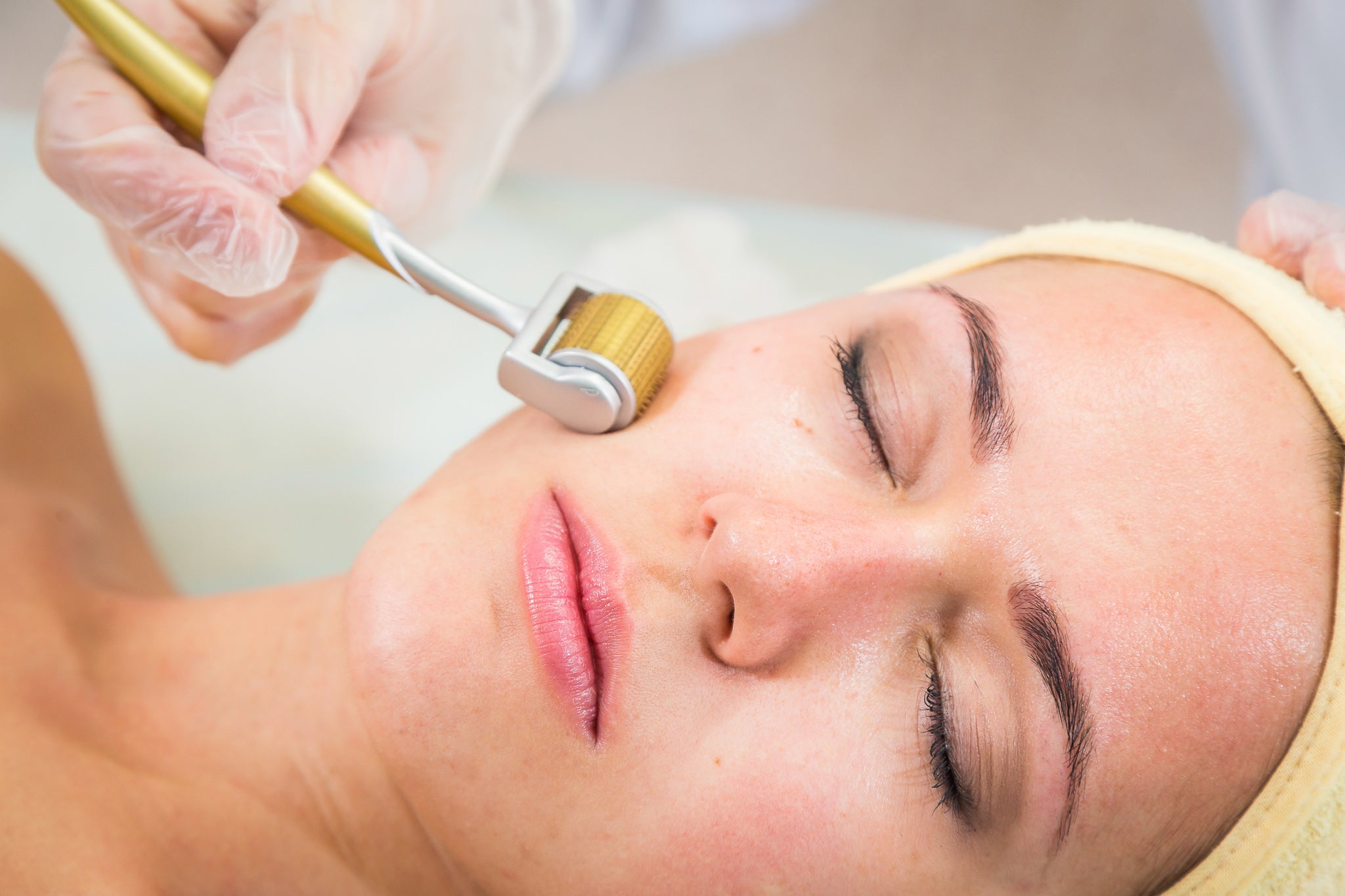 Woman getting a roller needling treatment