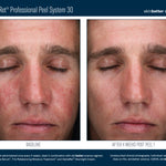 Before and after comparison of a man's face using AlphaRet Professional Peel System 30 by skinbetter science.
