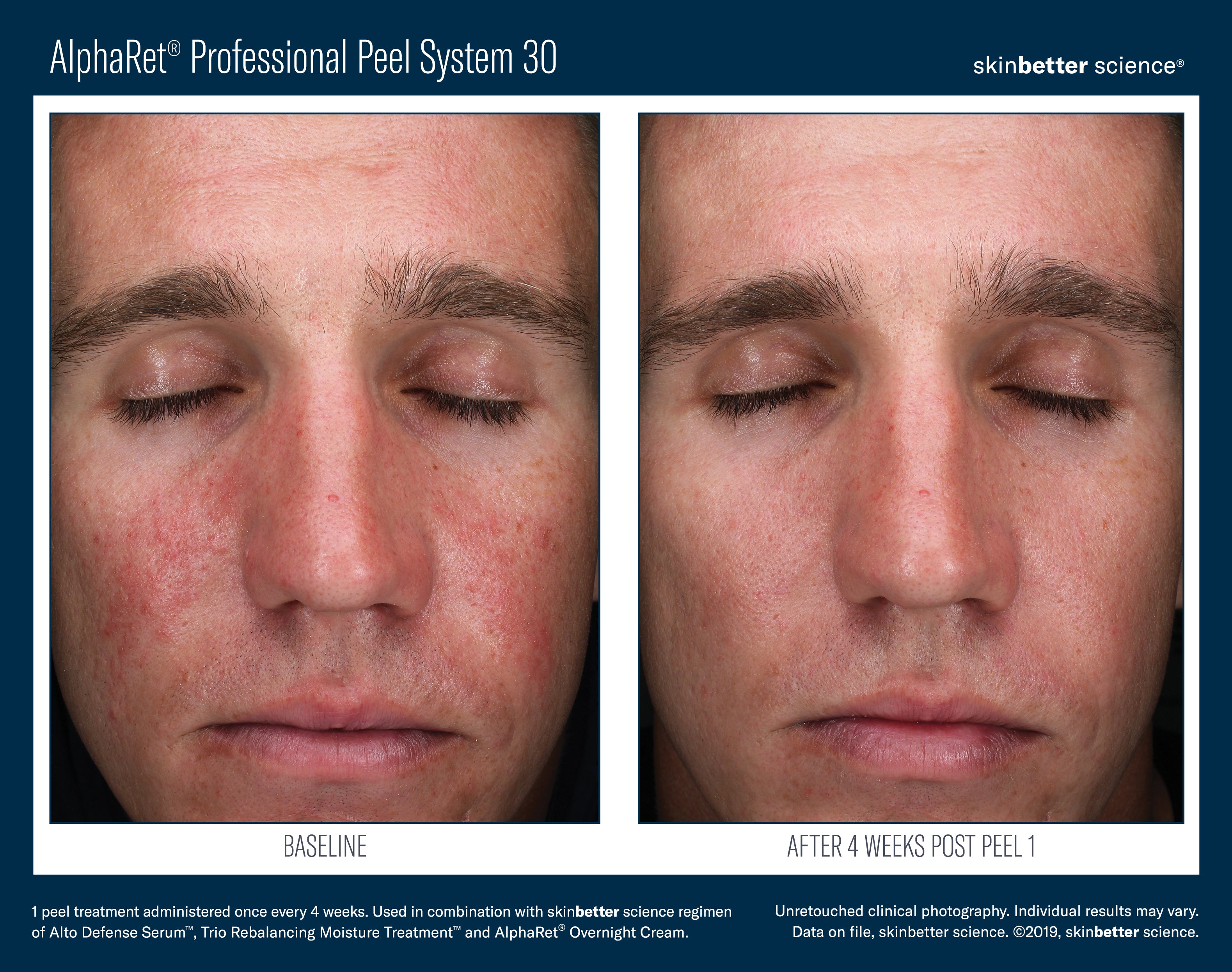 Before and after comparison of a man's face using AlphaRet Professional Peel System 30 by skinbetter science.