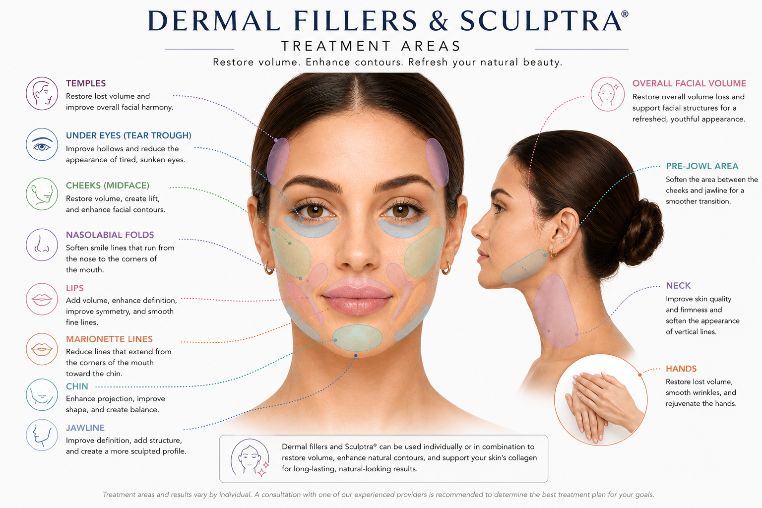 Diagram of Dermal Fillers & Sculptra treatment areas on a woman's face and neck.