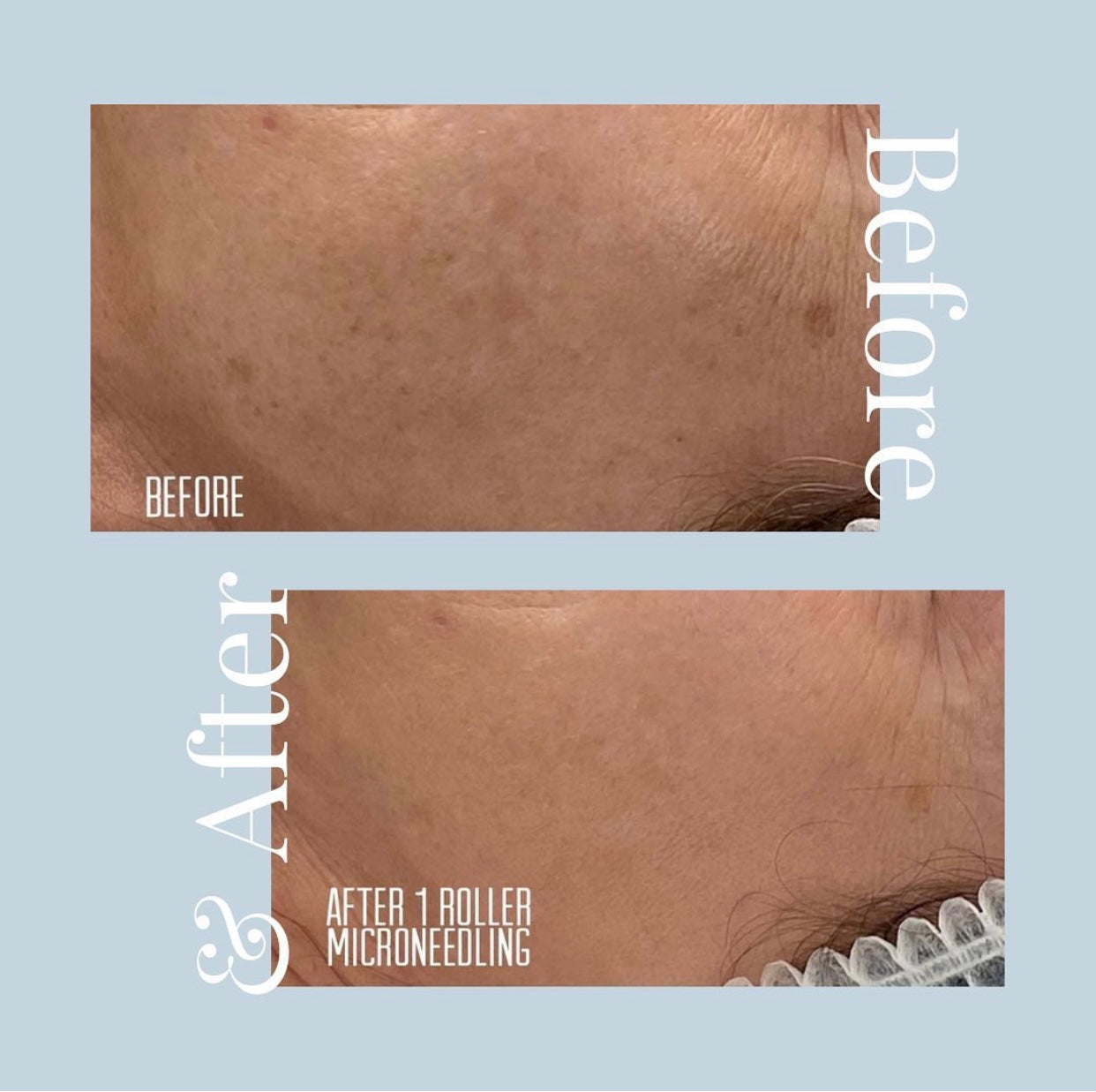 Before and After image of a Skin365 procedure