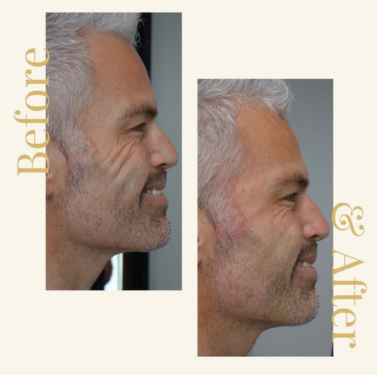 Before and After image of a Skin365 procedure