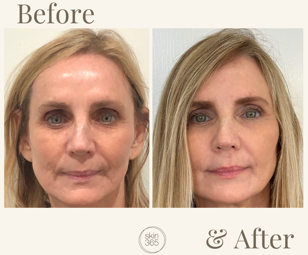 Restylane Collection Restylane® Collection – Skin365