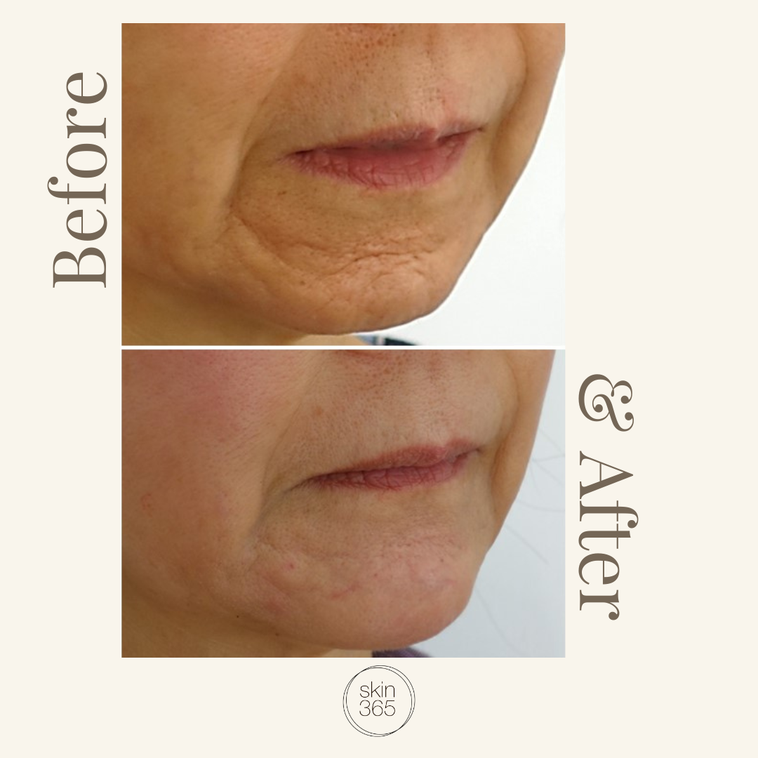 Before and after comparison of a person's lower face and mouth area, showing skin texture improvement, on a light beige background with 'Before', 'After', and a small 'skin 365' logo.