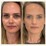 Side-by-side comparison of a woman's face before and after injectable treatments