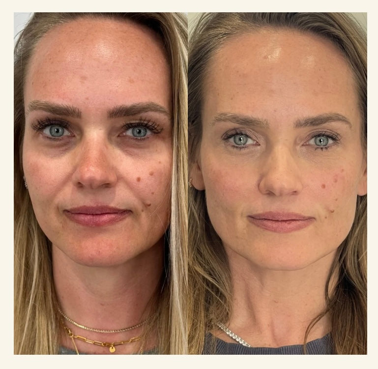 Side-by-side comparison of a woman's face before and after injectable treatments