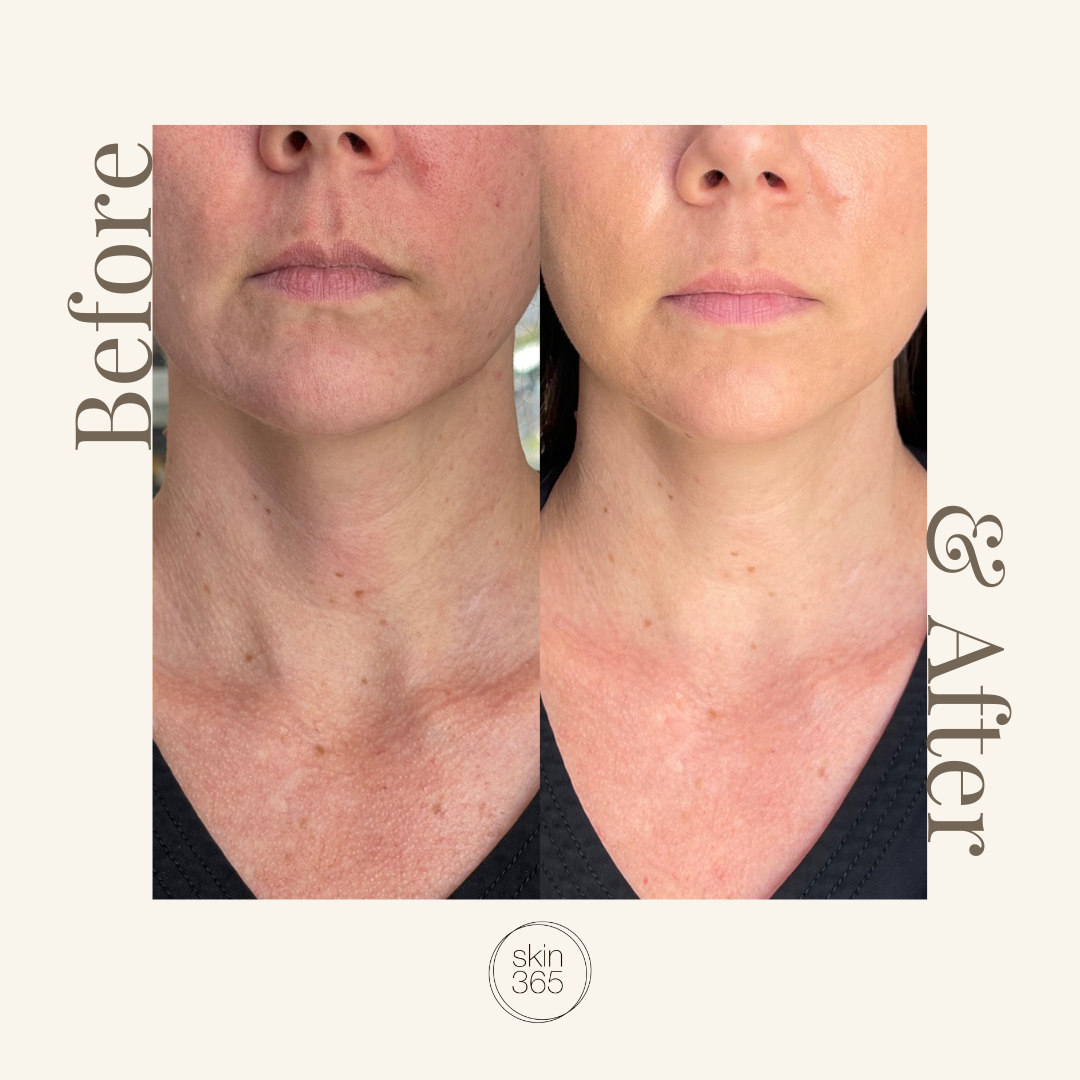 Before and after comparison of a woman's neck and lower face showing skin improvement, with the text 'Before' on the left, '& After' on the right, and a 'skin 365' logo at the bottom on a beige background.