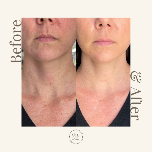 Before and after comparison of a woman's neck and lower face showing skin improvement, with the text 'Before' on the left, '& After' on the right, and a 'skin 365' logo at the bottom on a beige background.