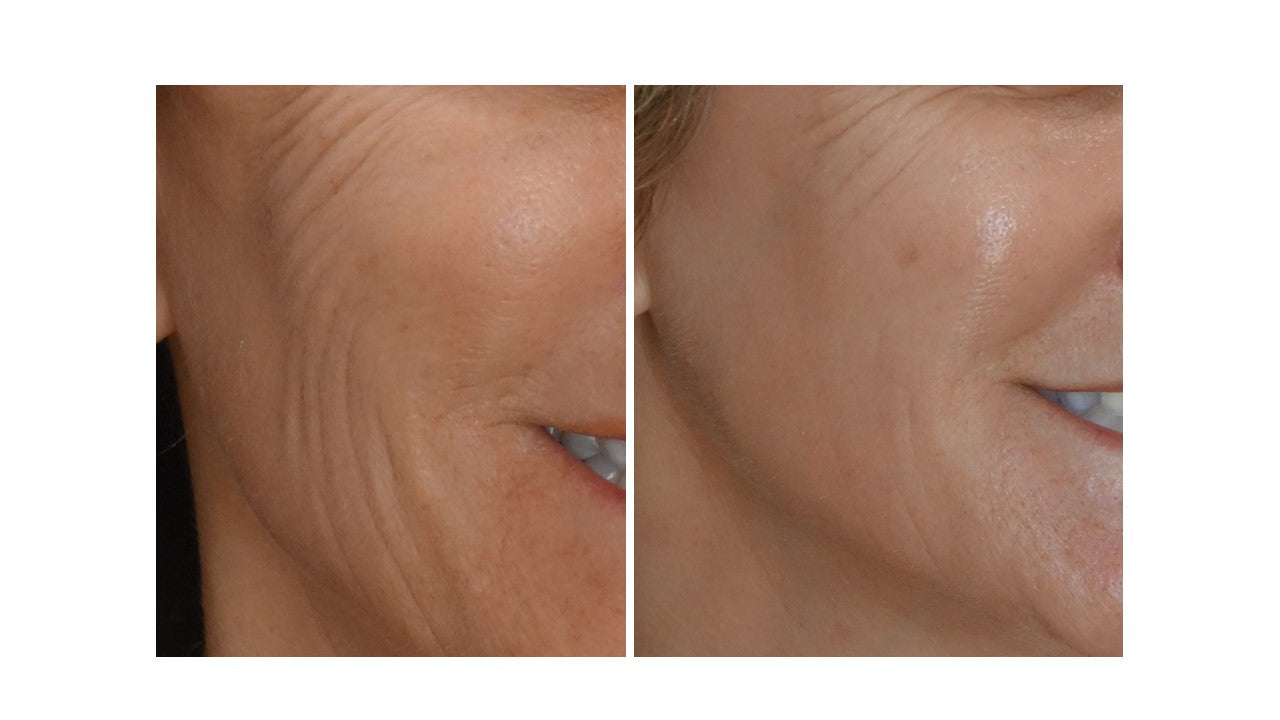 Before and after comparison of facial skin texture on a person's cheek.