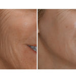 Before and after comparison of facial skin texture on a person's cheek.