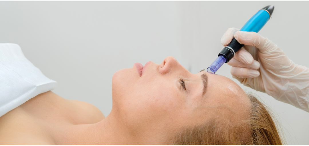 woman getting microneedling treatment